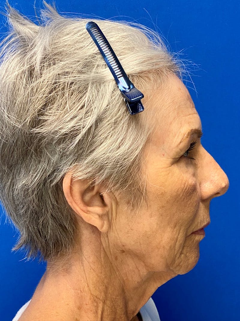 Neck Lift Before & After Gallery - Patient 151995900 - Image 5