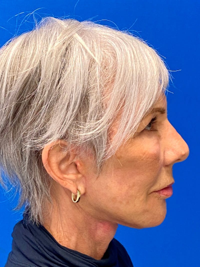 Neck Lift Before & After Gallery - Patient 151995900 - Image 6