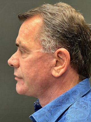 Facelift Before & After Gallery - Patient 152861283 - Image 4