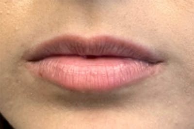 Lip Filler Before & After Gallery - Patient 155413442 - Image 1