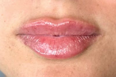 Lip Filler Before & After Gallery - Patient 155413442 - Image 2