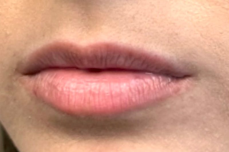 Lip Filler Before & After Gallery - Patient 155413442 - Image 3