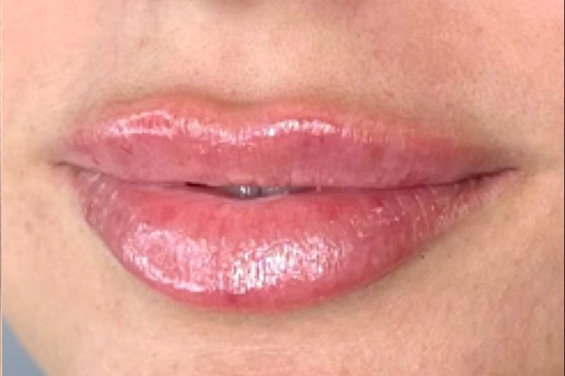 Lip Filler Before & After Gallery - Patient 155413442 - Image 4