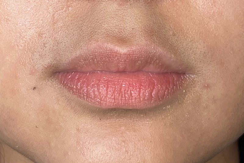 Lip Filler Before & After Gallery - Patient 158793418 - Image 1