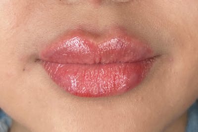 Lip Filler Before & After Gallery - Patient 158793418 - Image 2