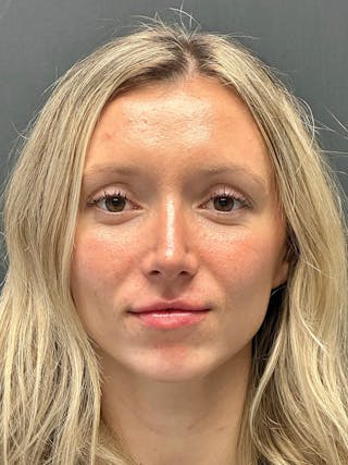 Primary Rhinoplasty Before & After Gallery - Patient 122921815 - Image 4