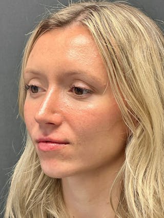 Primary Rhinoplasty Before & After Gallery - Patient 122921815 - Image 6