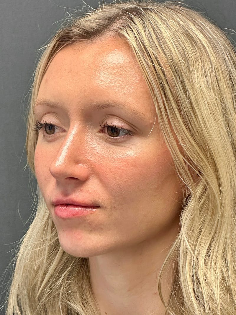 Rhinoplasty Before & After Gallery - Patient 122921815 - Image 4