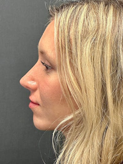 Primary Rhinoplasty Before & After Gallery - Patient 122921815 - Image 2