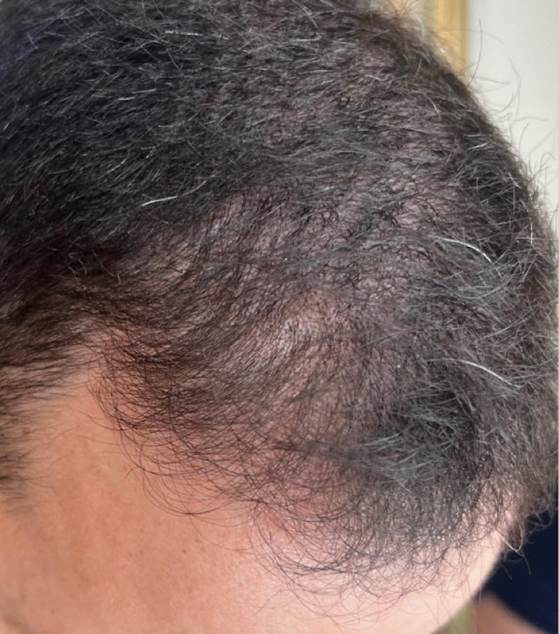 Hair Restoration Before & After Gallery - Patient 170139873 - Image 3