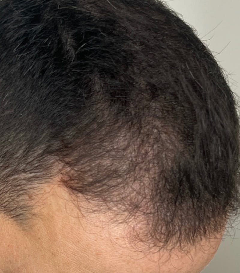 Hair Restoration Before & After Gallery - Patient 170139873 - Image 4