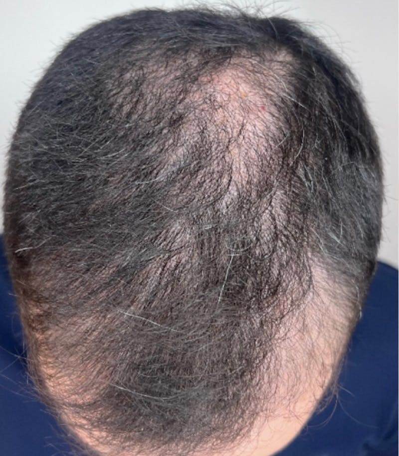Hair Restoration Before & After Gallery - Patient 170139873 - Image 5