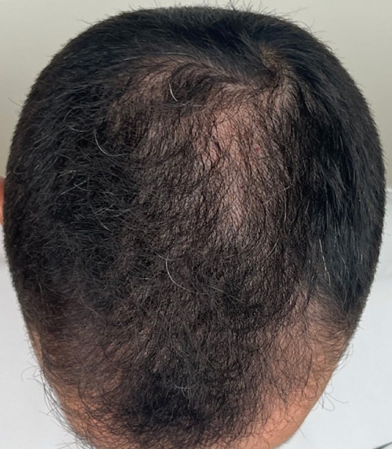 Hair Restoration Before & After Gallery - Patient 170139873 - Image 6