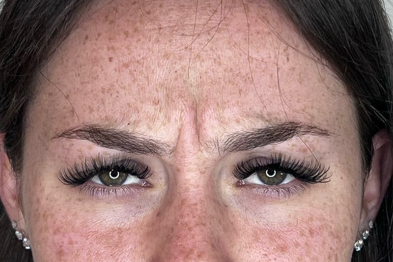 BOTOX Before & After Gallery - Patient 170140039 - Image 5
