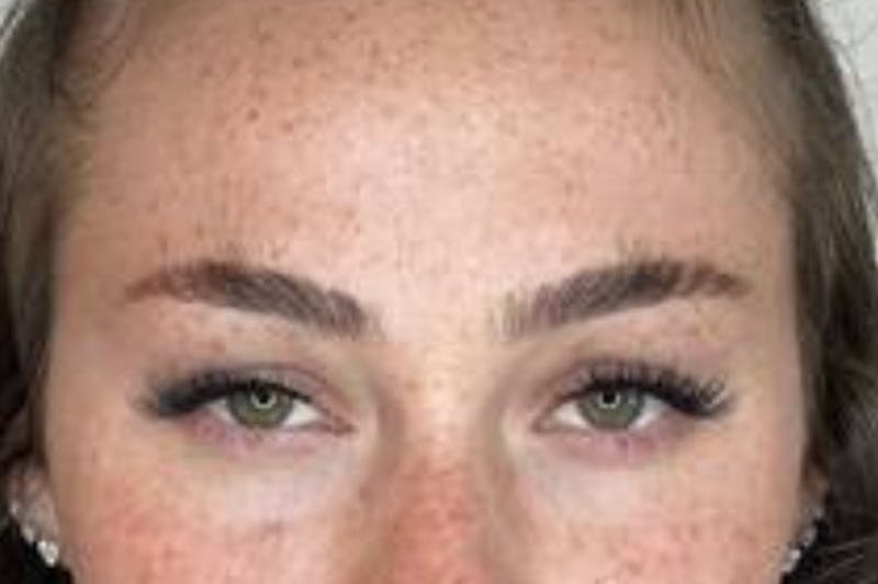 BOTOX Before & After Gallery - Patient 170140039 - Image 6