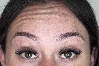 BOTOX Before & After Gallery - Patient 170140039 - Image 1