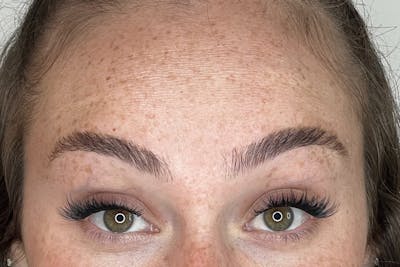 BOTOX Before & After Gallery - Patient 170140039 - Image 2
