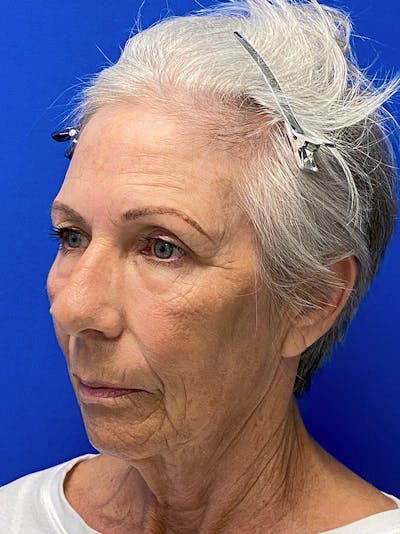 Neck Lift Before & After Gallery - Patient 170712243 - Image 1