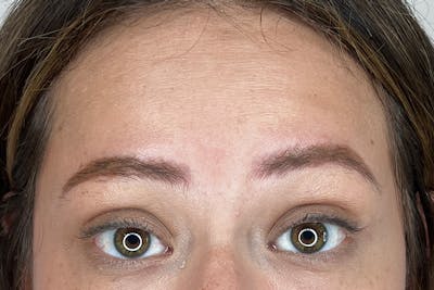 BOTOX Before & After Gallery - Patient 171337506 - Image 1