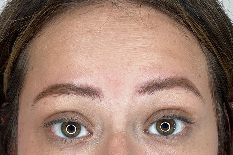 BOTOX Before & After Gallery - Patient 171337506 - Image 1