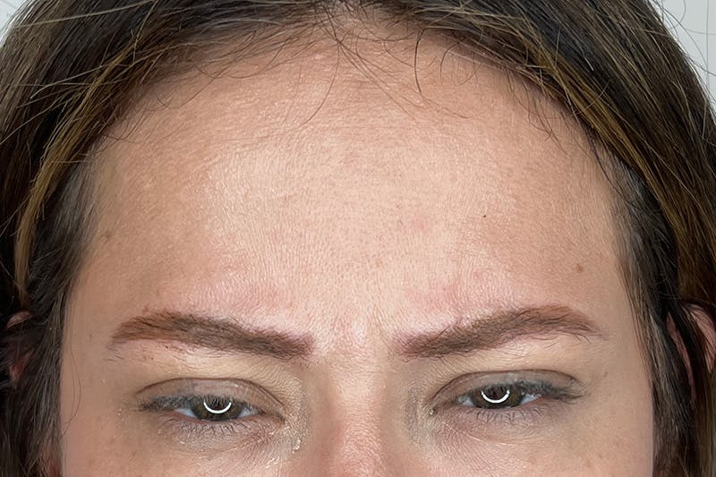 BOTOX Before & After Gallery - Patient 171337506 - Image 3