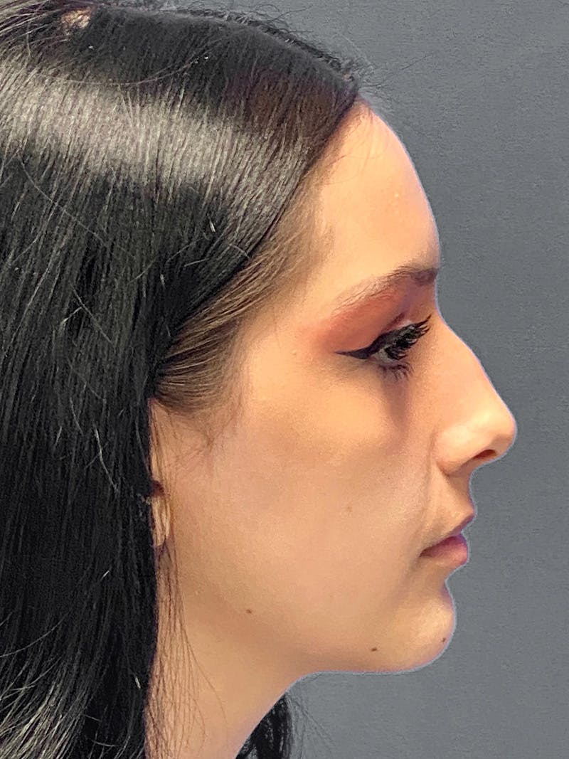 Rhinoplasty Before & After Gallery - Patient 177269736 - Image 5