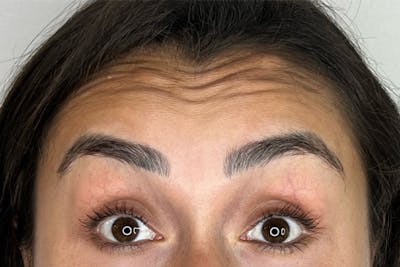 BOTOX Before & After Gallery - Patient 181057971 - Image 1