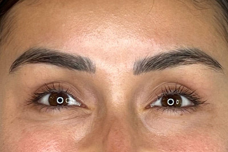 BOTOX Before & After Gallery - Patient 181057971 - Image 6