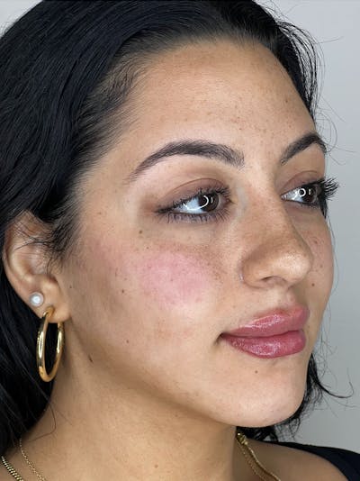 Facial Filler Before & After Gallery - Patient 181057975 - Image 2