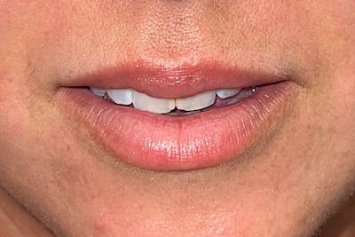 Lip Filler Before & After Gallery - Patient 181059229 - Image 1