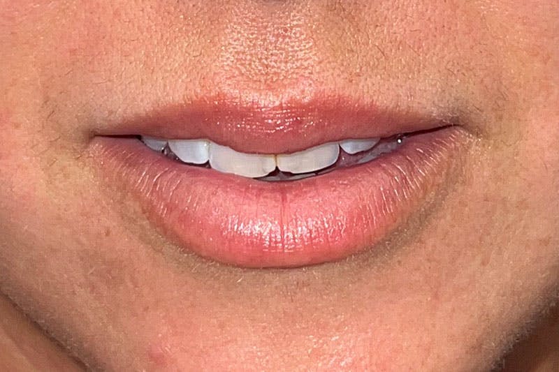 Lip Filler Before & After Gallery - Patient 181059229 - Image 1