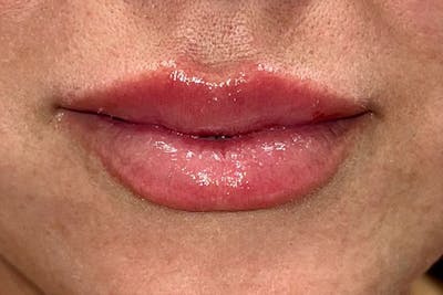 Lip Filler Before & After Gallery - Patient 181059229 - Image 2