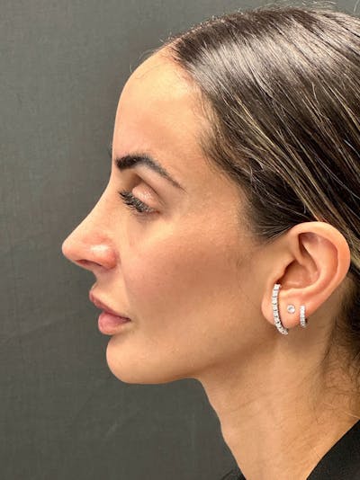 Primary Rhinoplasty Before & After Gallery - Patient 183561695 - Image 2