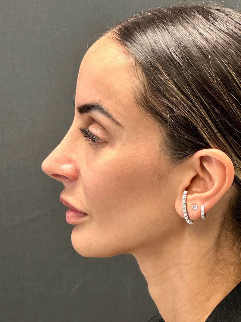 Rhinoplasty Before & After Gallery - Patient 183561695 - Image 6
