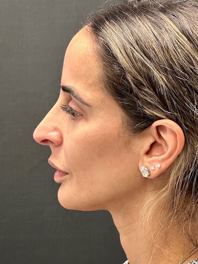 Primary Rhinoplasty Before & After Gallery - Patient 183561695 - Image 1