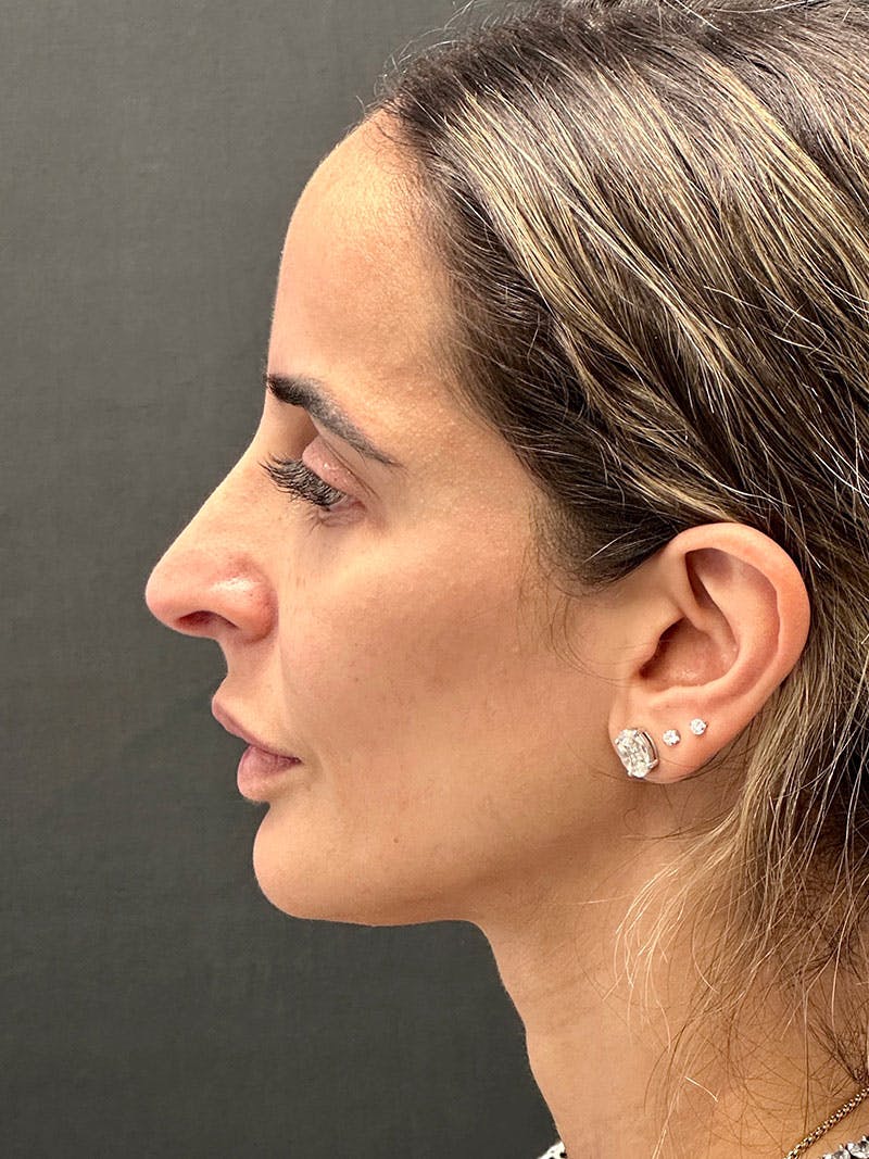 Primary Rhinoplasty Before & After Gallery - Patient 183561695 - Image 5