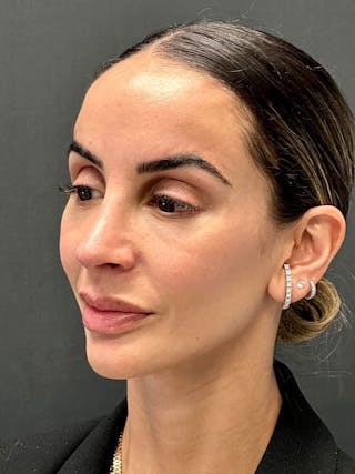 Brow Lift Before & After Gallery - Patient 183561693 - Image 4