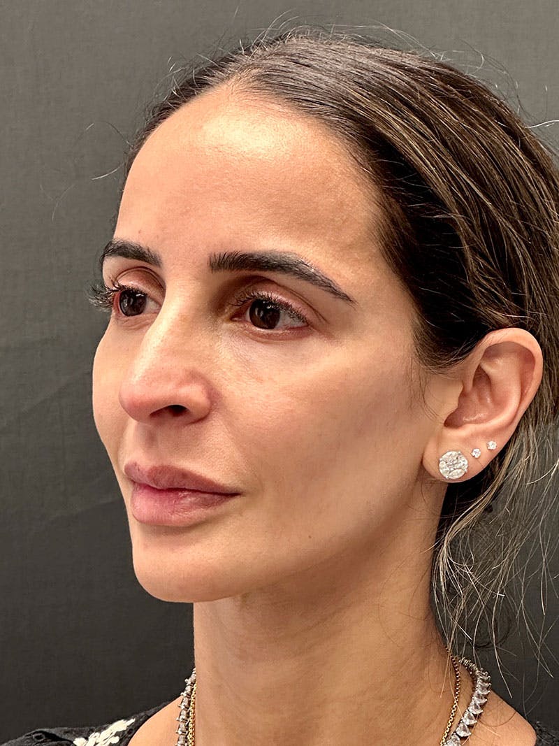 Primary Rhinoplasty Before & After Gallery - Patient 183561695 - Image 3