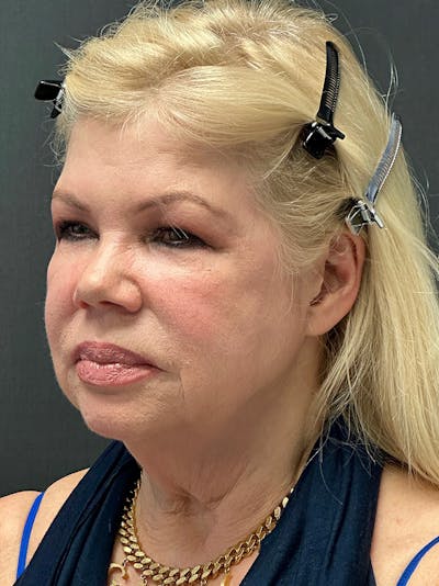 Neck Lift Before & After Gallery - Patient 185847562 - Image 1