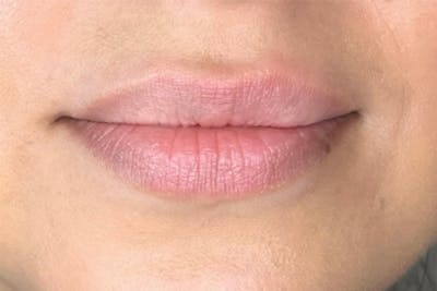 Lip Filler Before & After Gallery - Patient 189142736 - Image 1