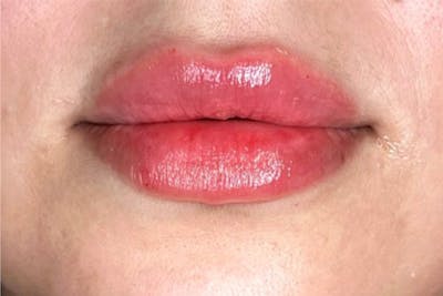 Lip Filler Before & After Gallery - Patient 189142736 - Image 2