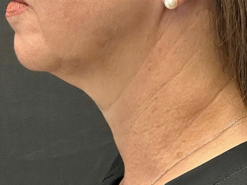 Neck Lift Before & After Gallery - Patient 192265888 - Image 1