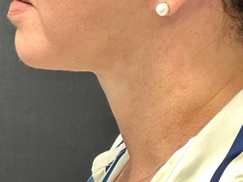 Neck Lift Before & After Gallery - Patient 192265888 - Image 2