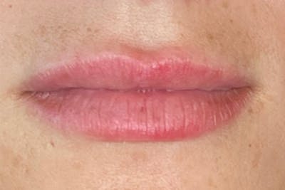 Lip Filler Before & After Gallery - Patient 192290640 - Image 1
