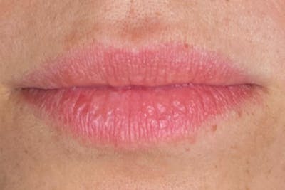 Lip Filler Before & After Gallery - Patient 192290663 - Image 1