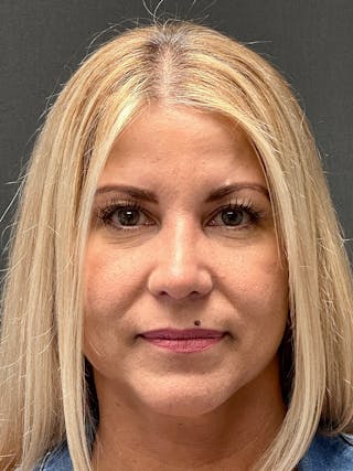 Primary Rhinoplasty Before & After Gallery - Patient 194520679 - Image 4