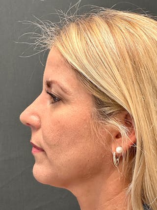 Primary Rhinoplasty Before & After Gallery - Patient 194520679 - Image 2