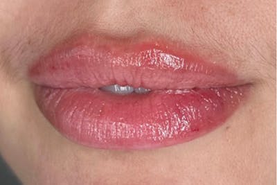 Lip Filler Before & After Gallery - Patient 195959131 - Image 2