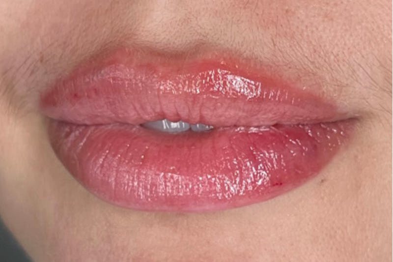 Lip Filler Before & After Gallery - Patient 195959131 - Image 2
