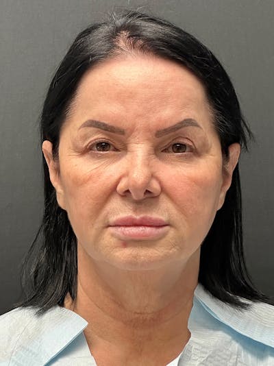 Facelift Before & After Gallery - Patient 636716 - Image 1